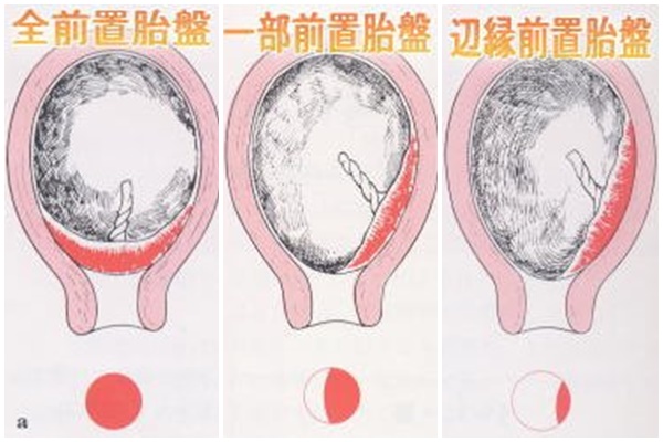 前置胎盤の種類